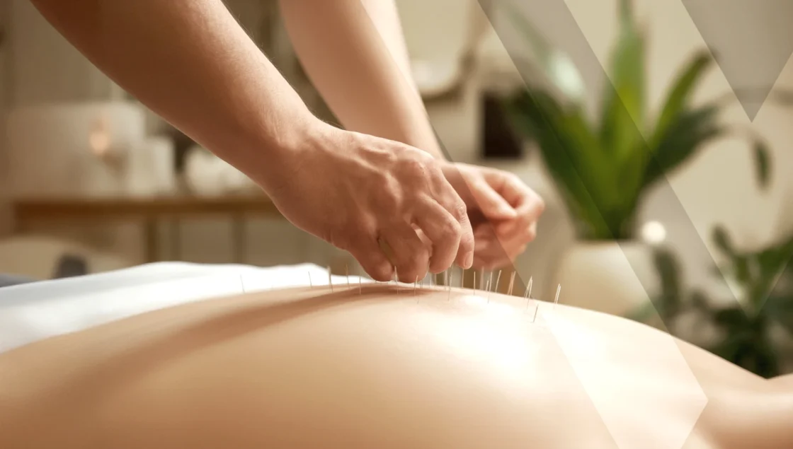 Dry Needling